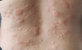 जाडो मौसममा यसरी गर्नुहोस् छालाको समस्याको समाधान